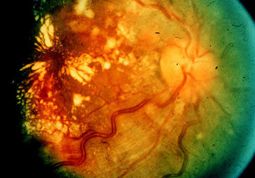 Hắc võng mạc trung tâm thanh dịch - Hình ảnh minh họa